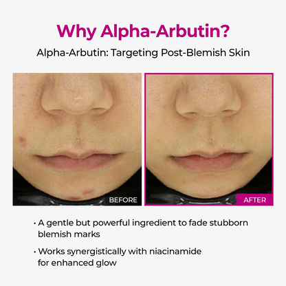 LUHAKA®  Poren & Pickelpflege Duo